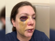 Kvinnen som ble slått ned i Cincinnati snakker ut