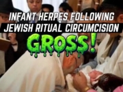 Dagens video: Enda et spedbarn får herpes etter jødisk omskjæringsritual